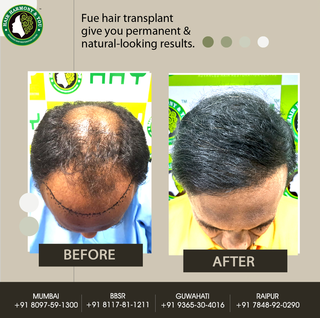 Hair Transplant Result